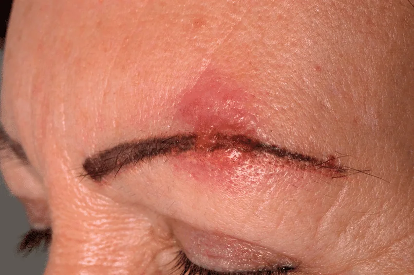 A woman with a red patch on her forehead, indicating an infection from an eyebrow piercing.