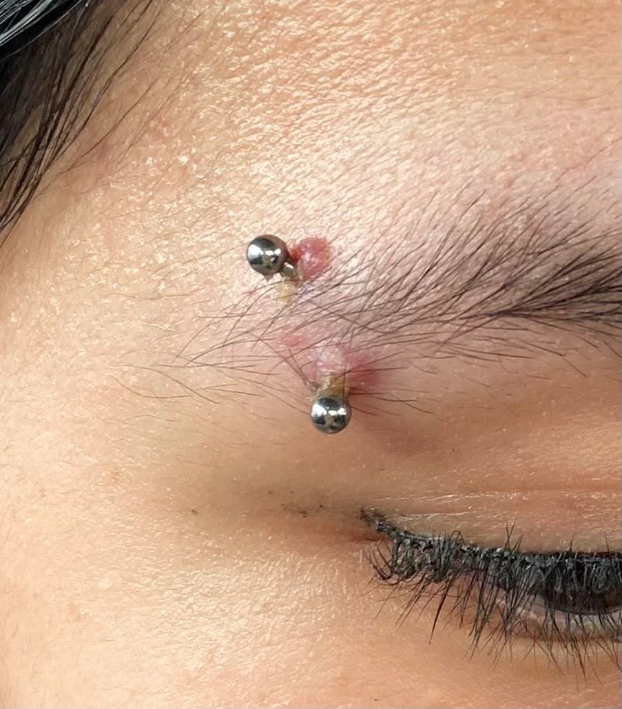 A woman displaying a forehead piercing, with a noticeable keloid as a side effect of her eyebrow piercing.