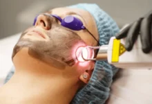 laser skin resurfacing